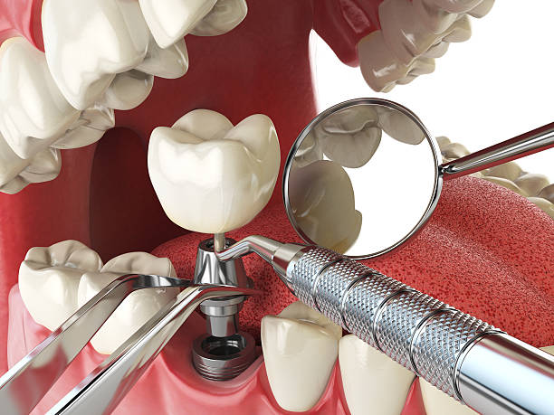 Best Emergency Wisdom Tooth Extraction in Meadowood, PA